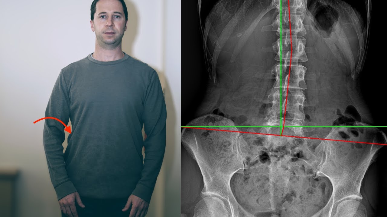 Scoliosis: The Curvature of the Spine