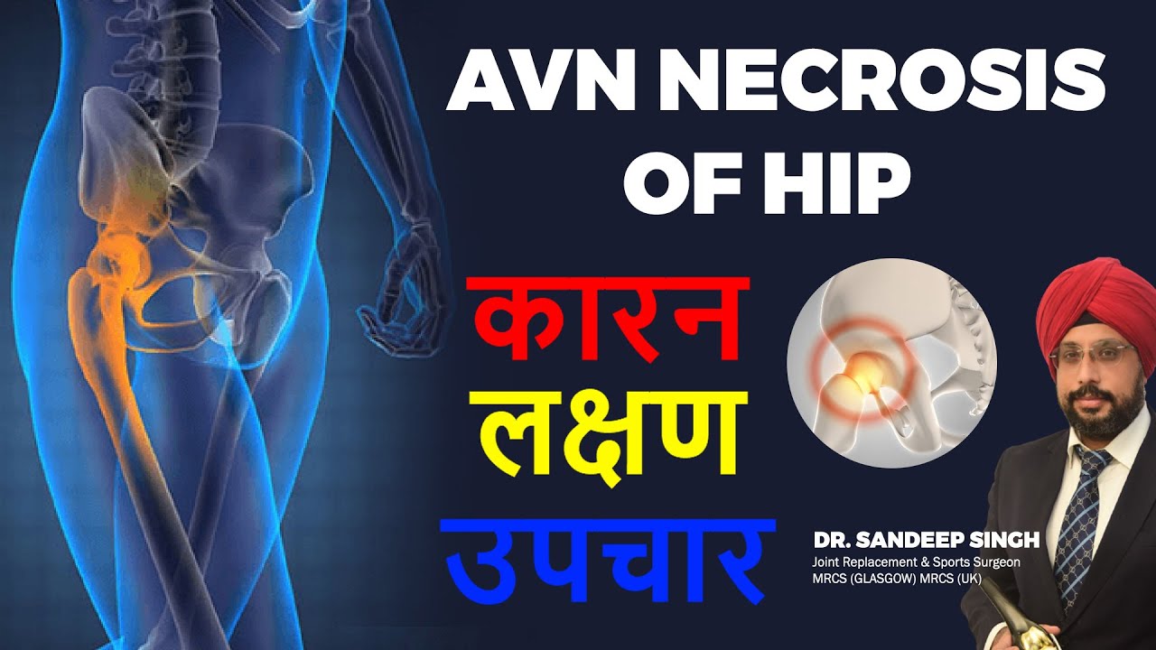 AVN Necrosis Of Hip जीवन को जीने का नई तरीका || AVN Hip || Dr. Sandeep Singh