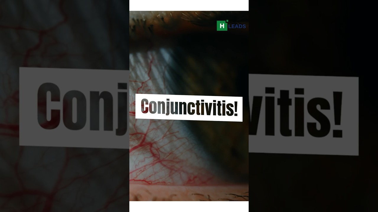 Monsoon 🌧️ Eye 👁️ Alert: Tackling the Conjunctivitis Outbreak! #health #eyeinfection #monsoon