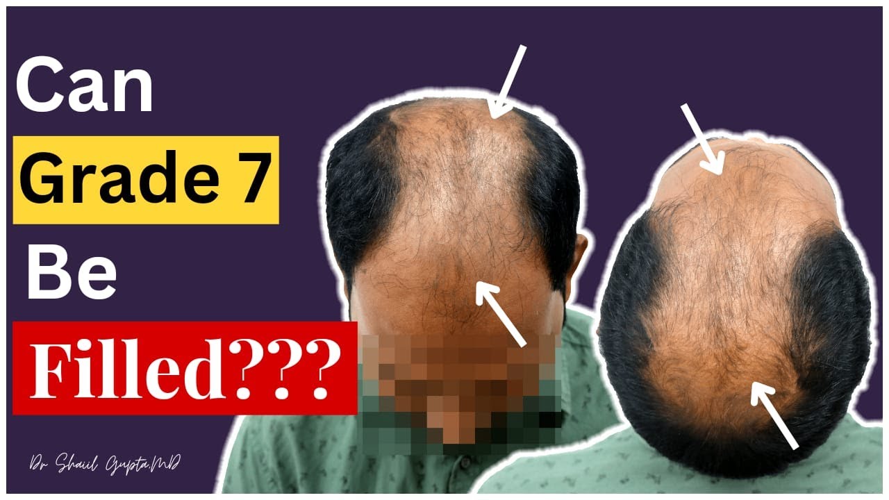 Grade 7 baldness | Grade 7 hair transplant | Grade 7 | Hair Transplant result timeline | FUT | FUE