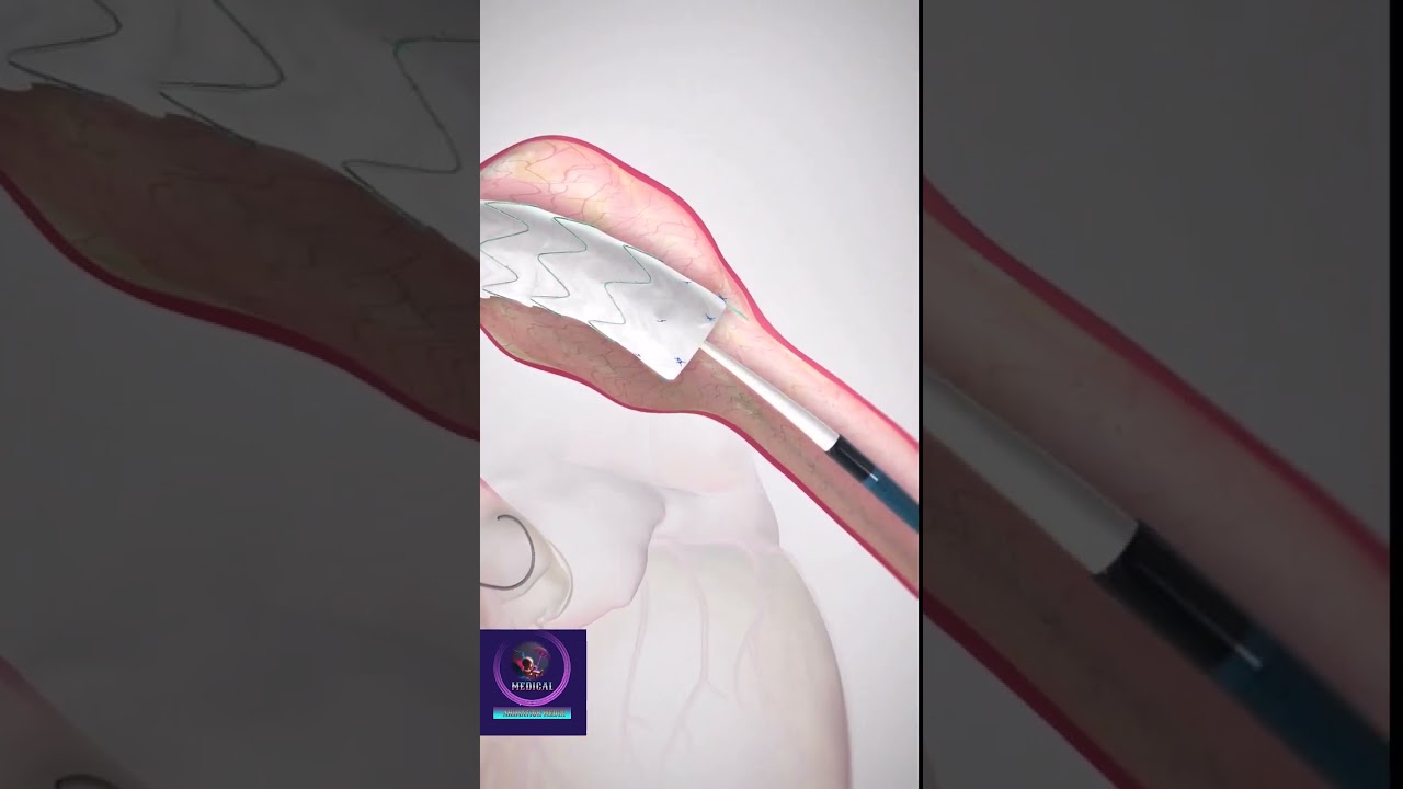 Aortic Stent Grafts -Thoracic Endovascular Aortic Repair #shorts