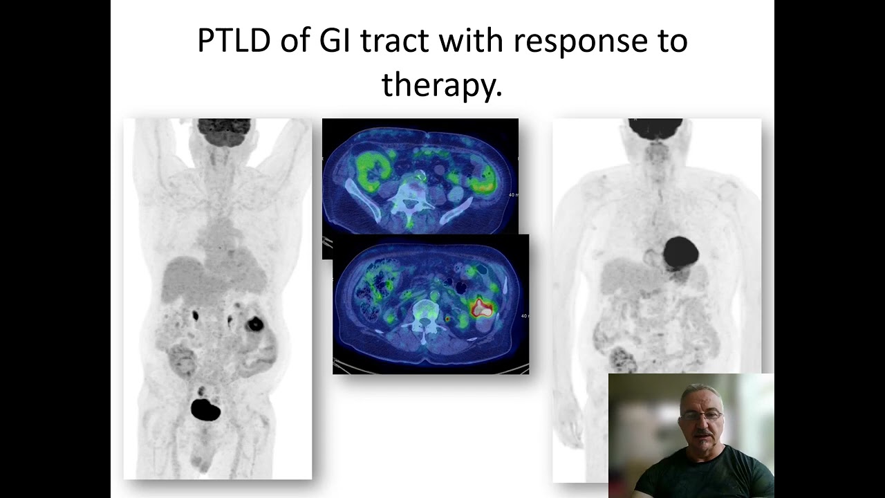 FDG PET in uncommon lymphomas - Dr Simon Hughes