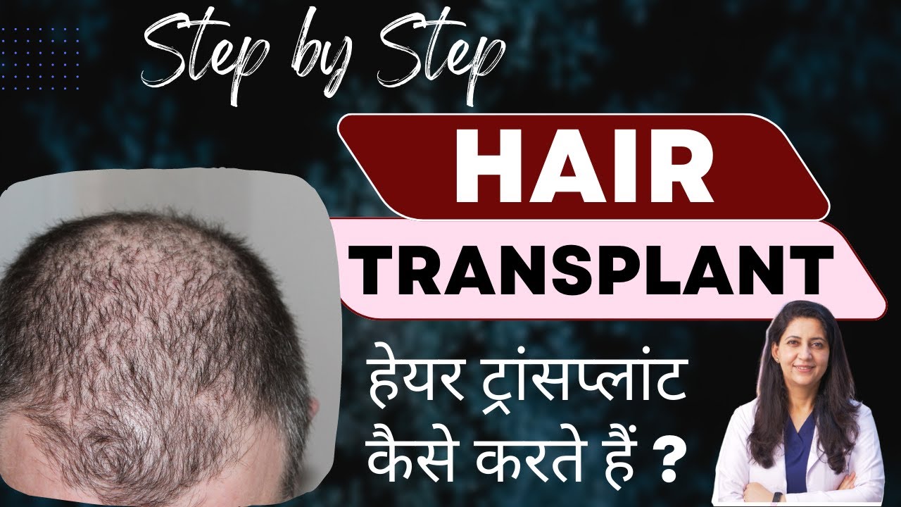 💹 हेयर ट्रांसप्लांट कैसे किया जाता है?👩🏿‍🦲 Hair Transplant Procedure Step by Step in Hindi | 