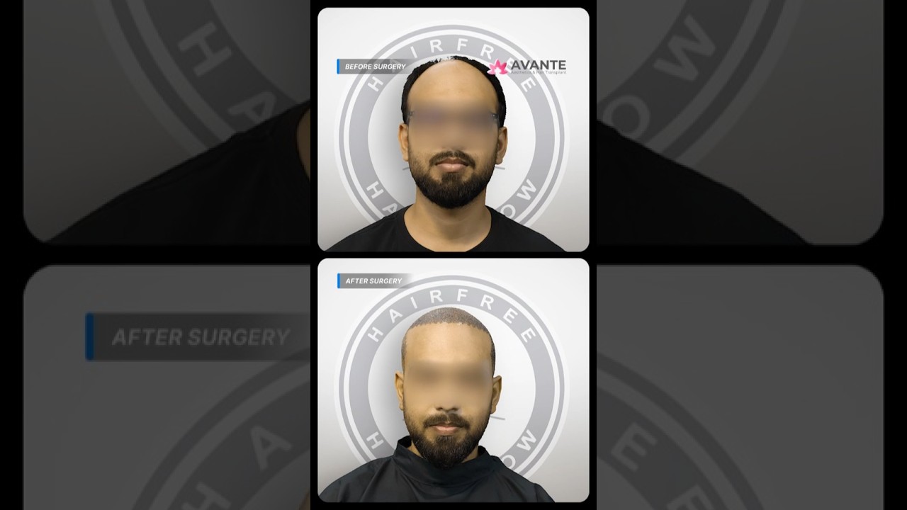 Hair Transplant Surgery in Bangladesh | 4000 Grafts | Grade 4 Baldness 