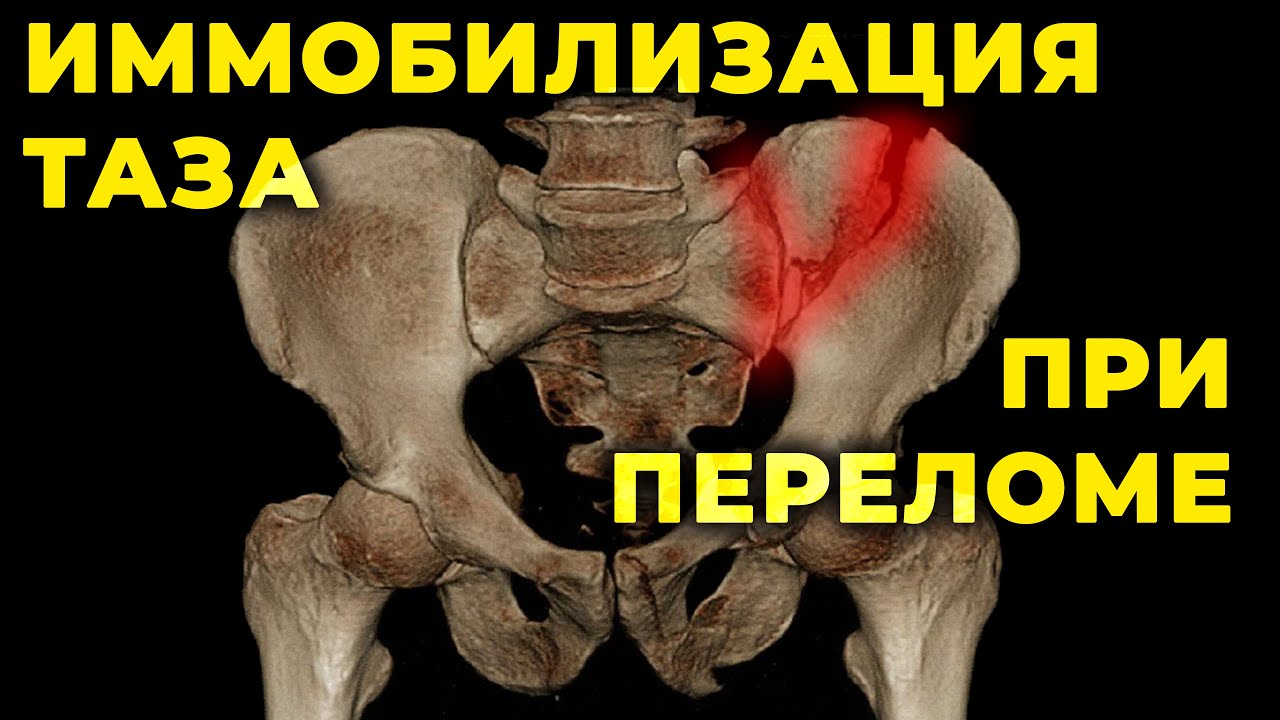 Перелом таза и тазовый пояс для иммобилизации. #ITLS #ПроСМП