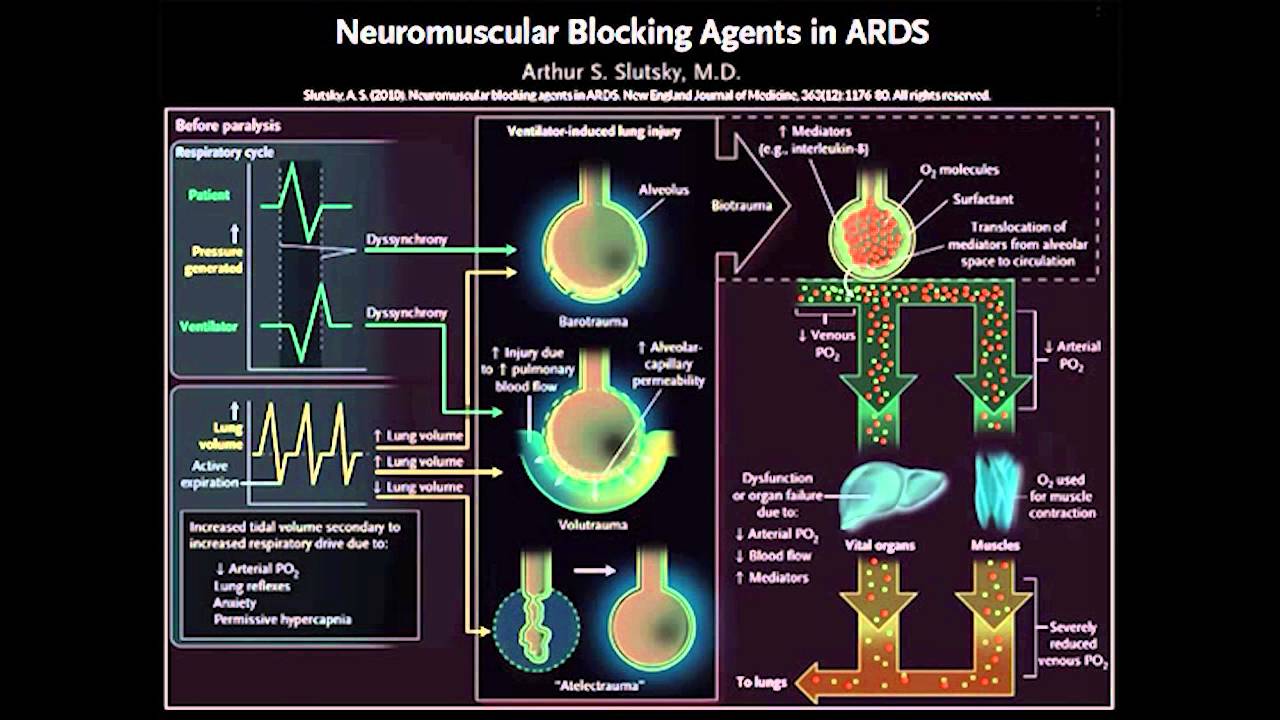 Why Spontaneous Breathing and Synchrony Matters by L. Brochard | OPENPediatrics