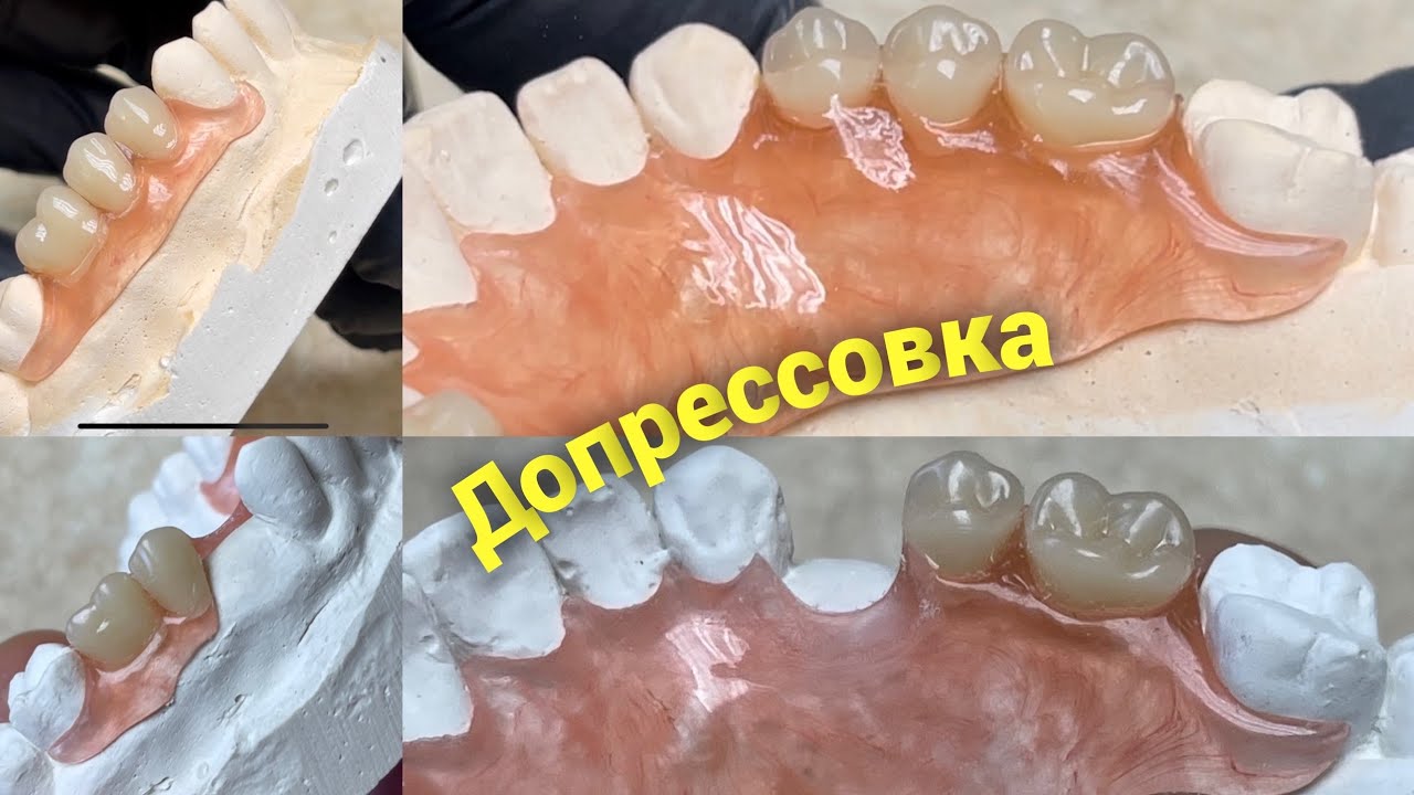 Починка нейлонового протеза, СЕКРЕТ ПРОСТ. Допрессовка термопласта . Зубной техник