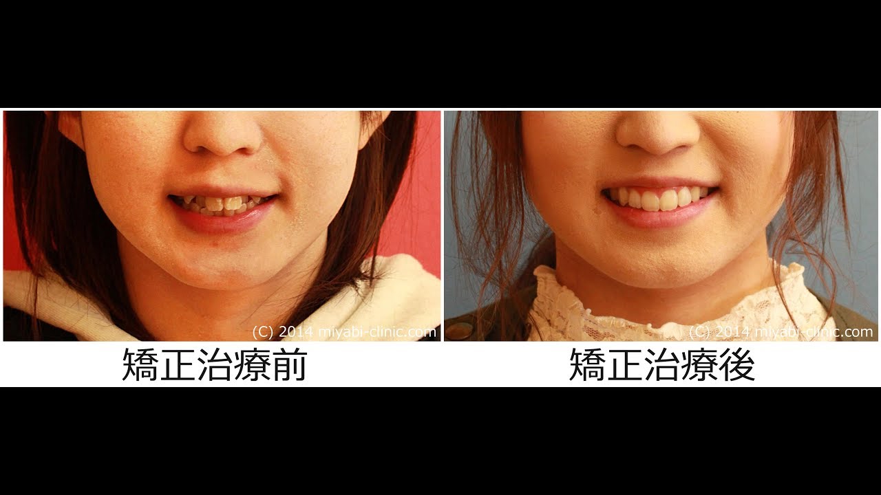 インビザラインによる治療「八重歯を治したい」19歳 女性 13か月