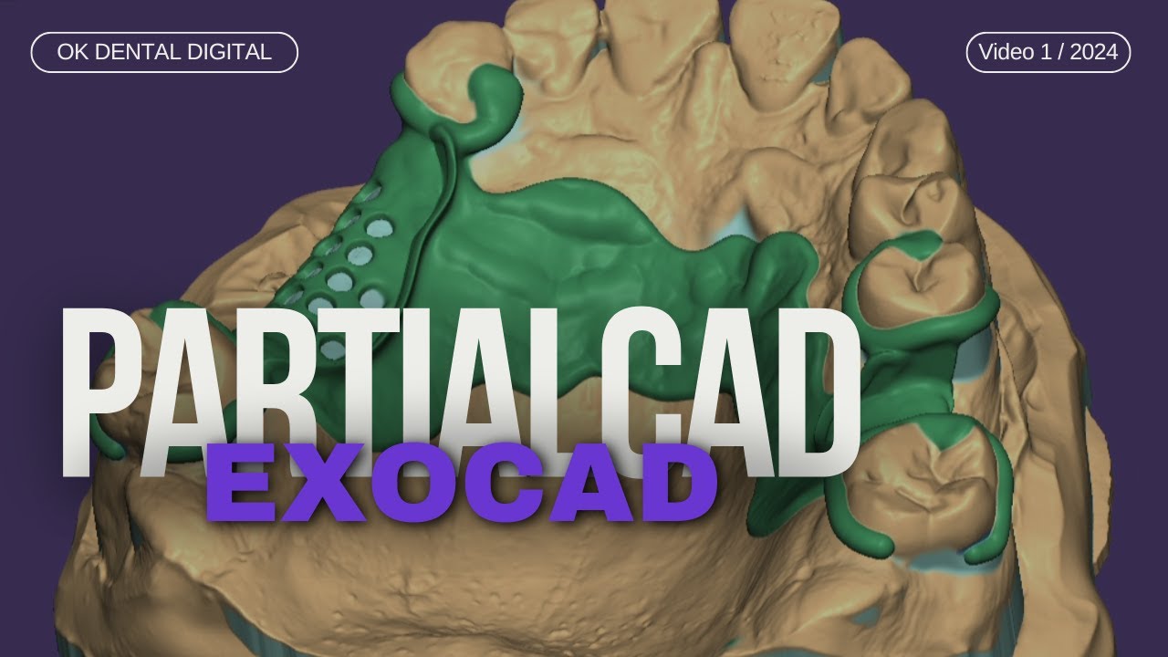 exocad partialcad diseño estructura superior  upper frame design