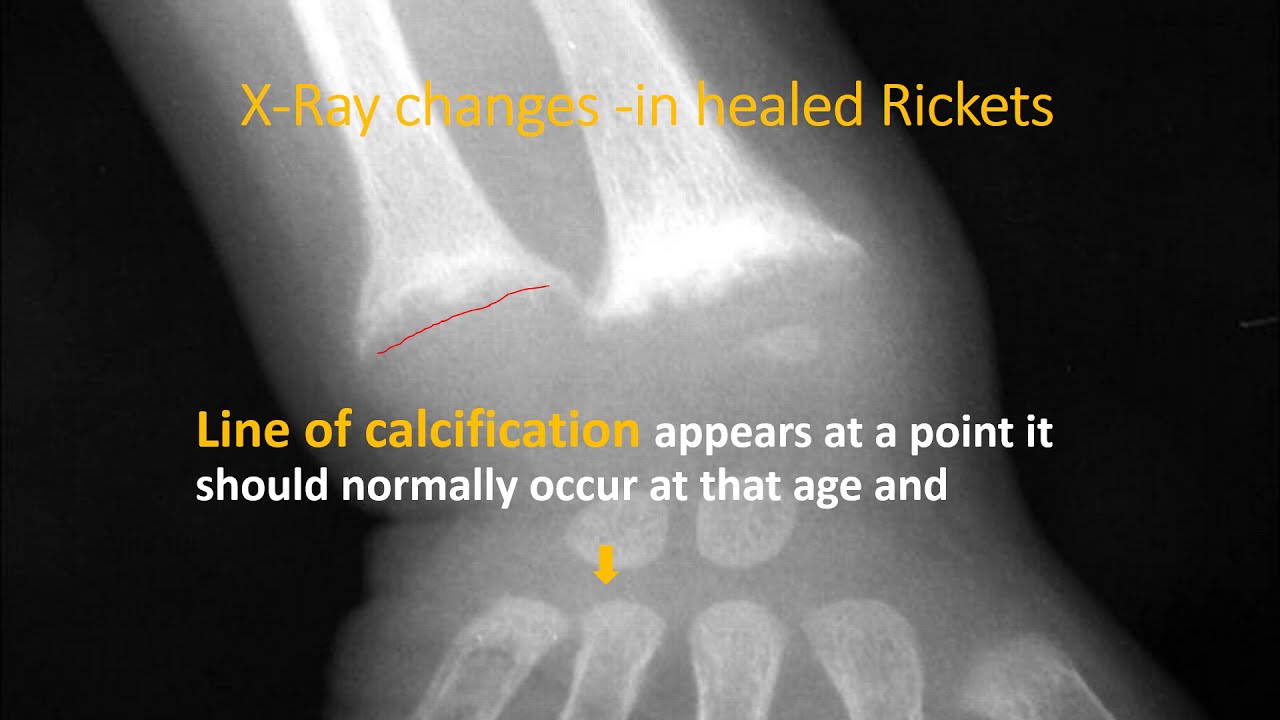 X-Ray wrist in rickets (Part 2/3) | Rickets | Pediatrics