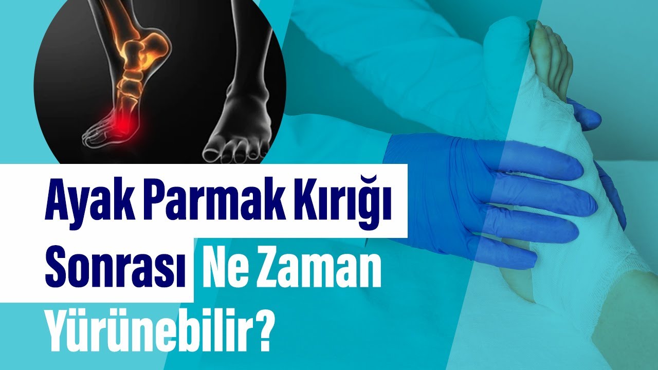 Ayak Parmak Kırığının Belirtileri Nelerdir? Ayak Parmak Kırığı Sonrası Ne Zaman Yürünebilir?