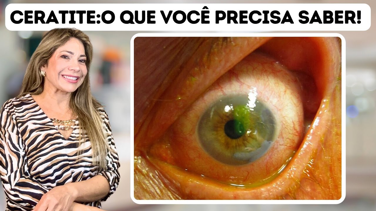 Ceratite: O Alerta que Seus Olhos Precisam Antes que Seja Tarde!