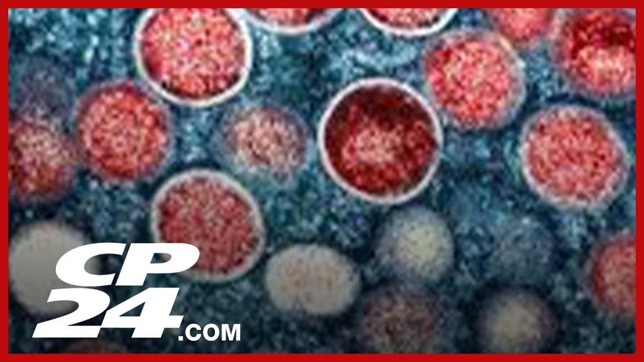 Toronto seeing 'spike' in mpox cases