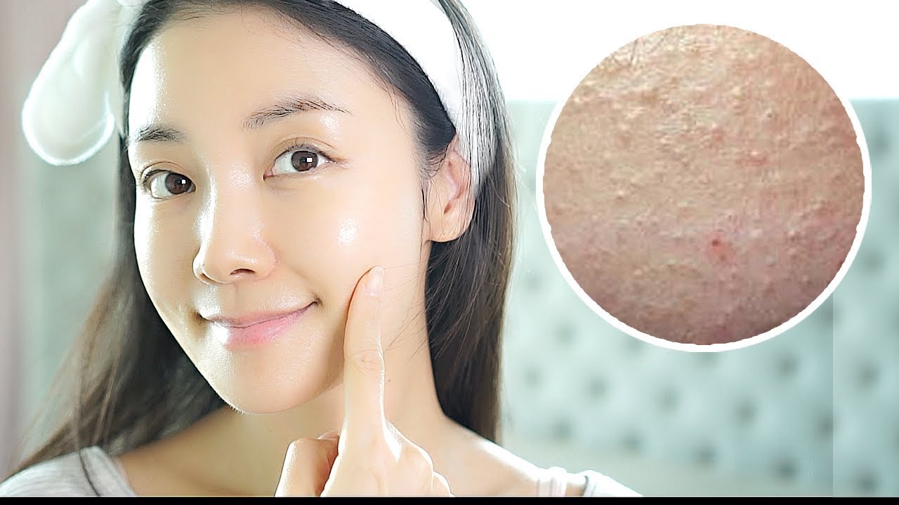 ENG) 좁쌀여드름! 스킨케어 이렇게 하세요 Skincare for Millet Seed Acne MSA | 뷰티클라우드 유나 UNA