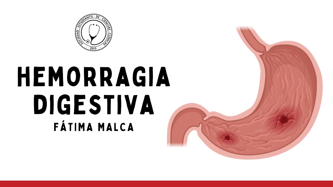 HEMORRAGIA DIGESTIVA: Clasificación, Etiologías, Manejo | Semiología