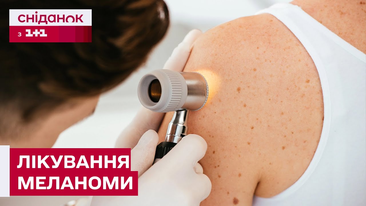Меланома: симптоми, діагностика та методи лікування!