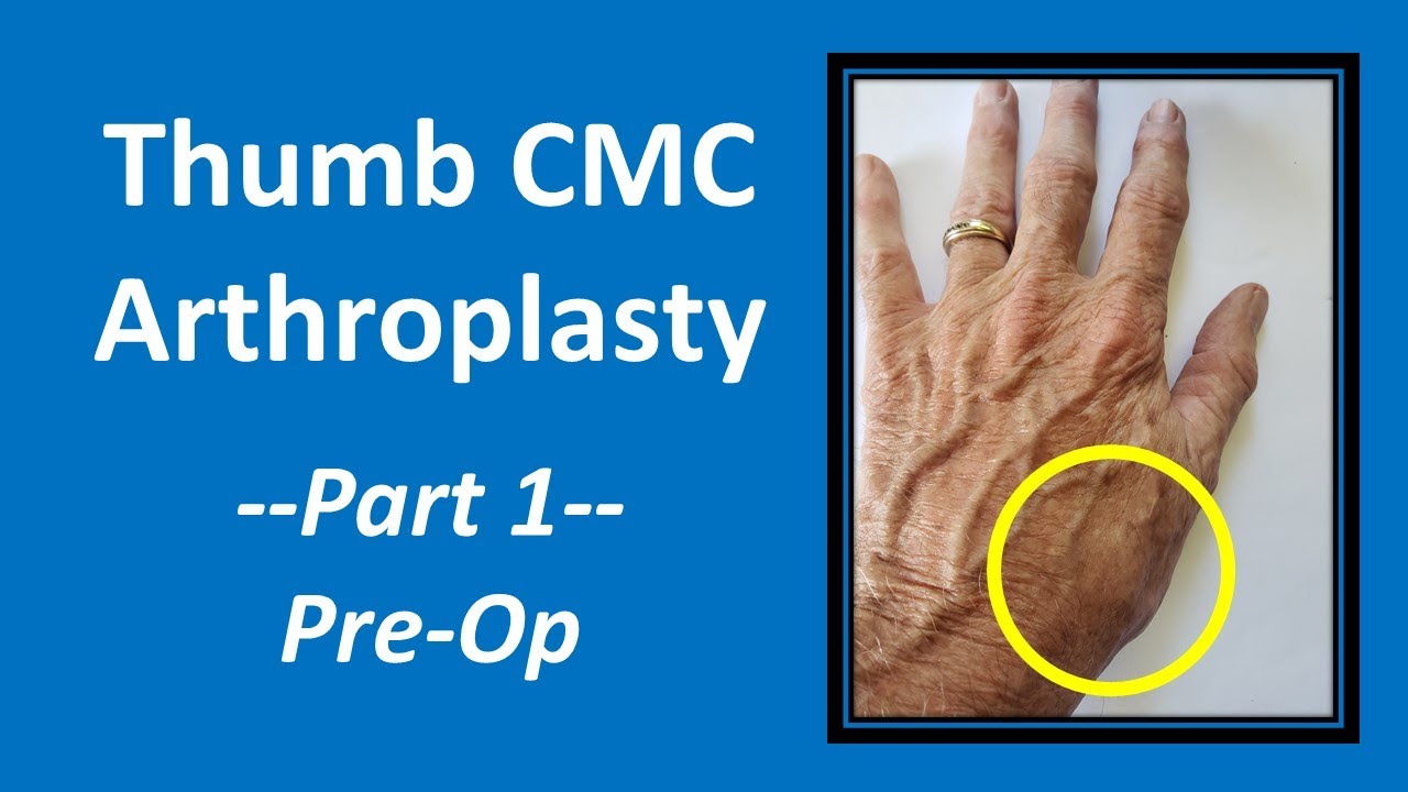 Thumb CMC Arthroplasty: Part 1 Pre-Op Explanation #cmc