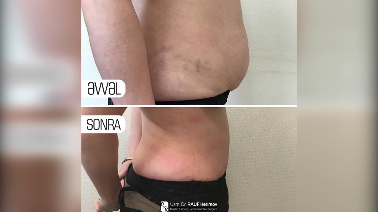 Abdominoplastika&nbsp;(qarın gərmə əməliyyatı) Uzm.Dr. Rauf Kerimov