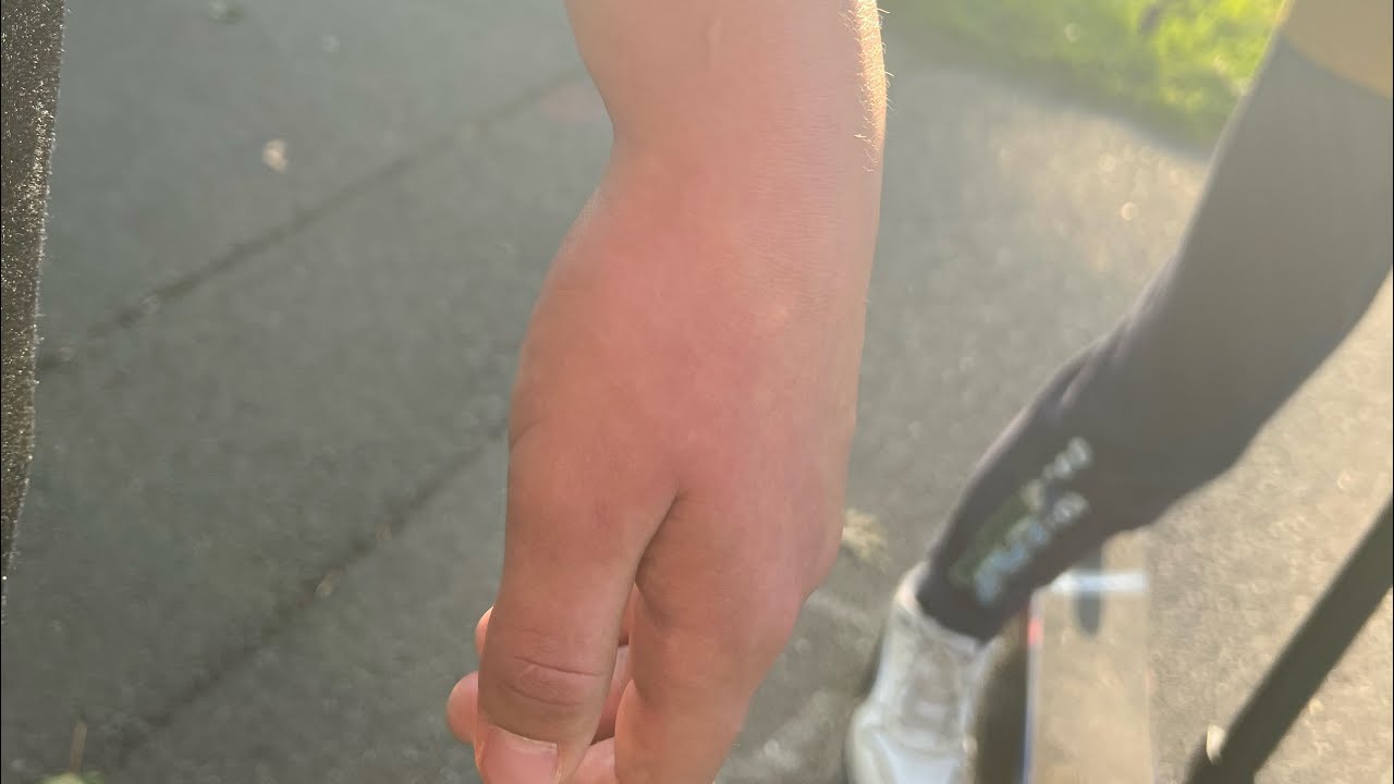 How I Seriously Broke my Wrist while “having fun” before the gym.