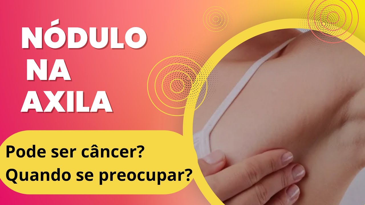 Linfonodo aumentado na axila: &eacute; c&acirc;ncer? Quando &eacute; preocupante?