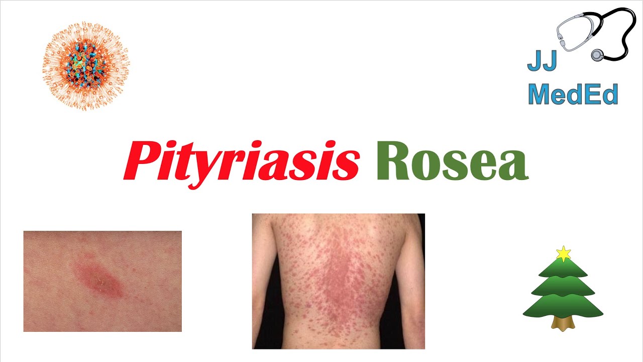 Introduction to Pityriasis Rosea | Possible Causes, Symptoms and Treatment
