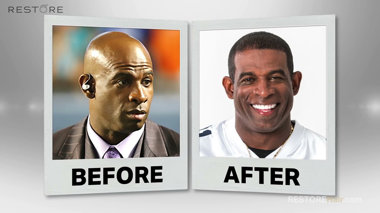 RESTORE&reg;  Hair | in Dallas | Hair Transplant