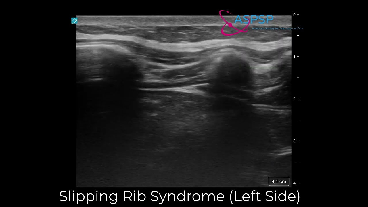 Slipping Rib Syndrome: Dynamic Ultrasound