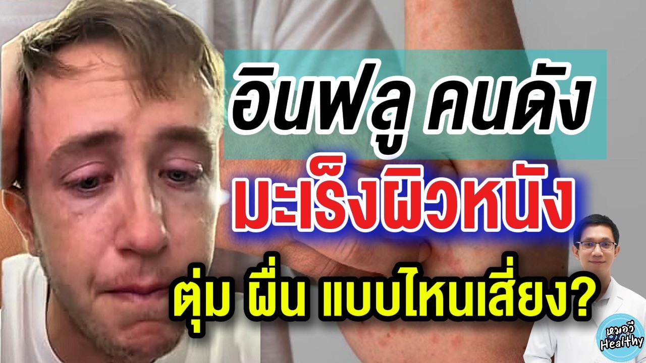 My mate Nate เป็นมะเร็งผิวหนัง สาเหตุและการป้องกันต้องทำอย่างไร? | หมอวี รอบโรคคนดัง