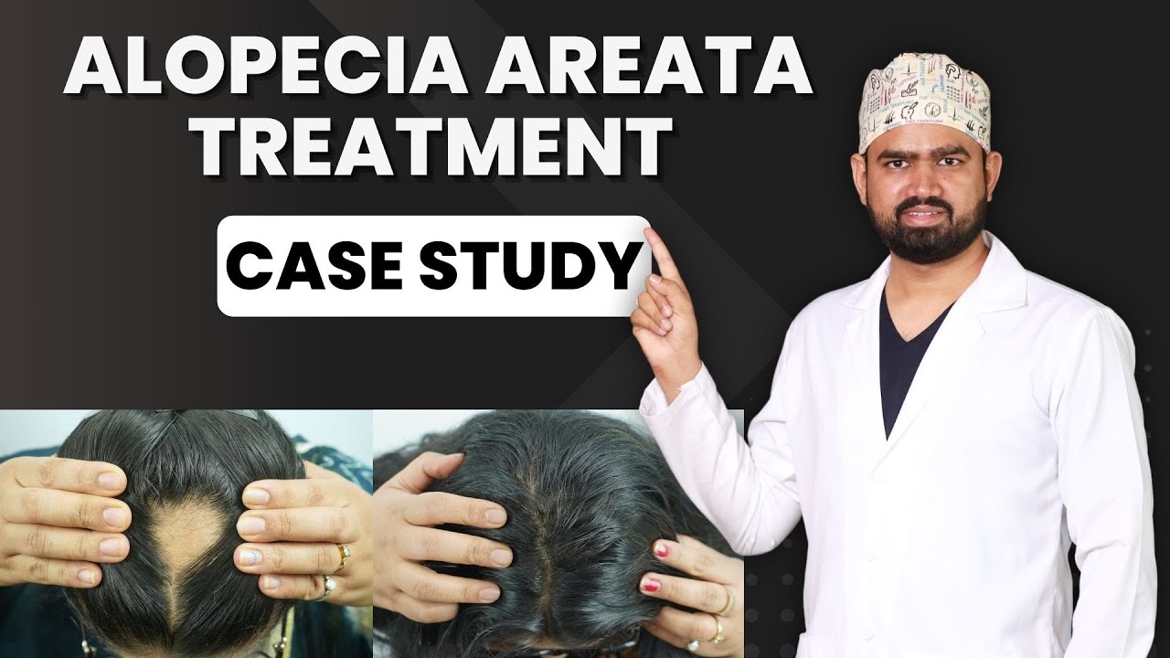 Alopecia Areata Treatment |  Dr. Kiran Chotaliya | Alopecia Areata Treatment for Hair Growth