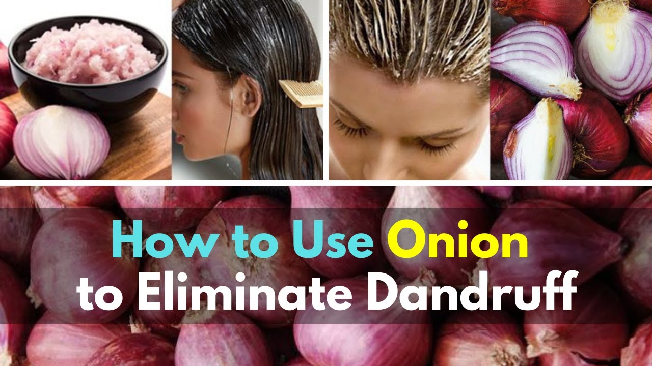 How to Use Onion to Eliminate Dandruff