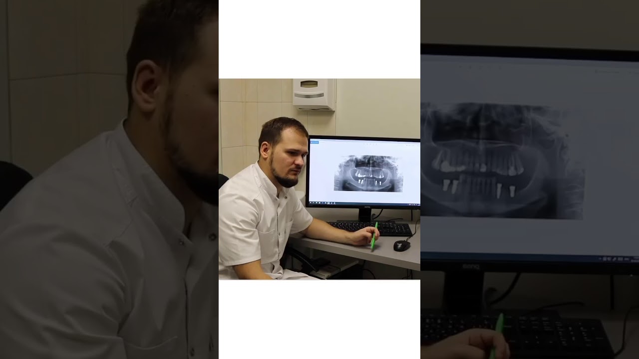 Что лучше - импланты или мост? Отвечает стоматолог-имплантолог👨‍⚕️🩺!