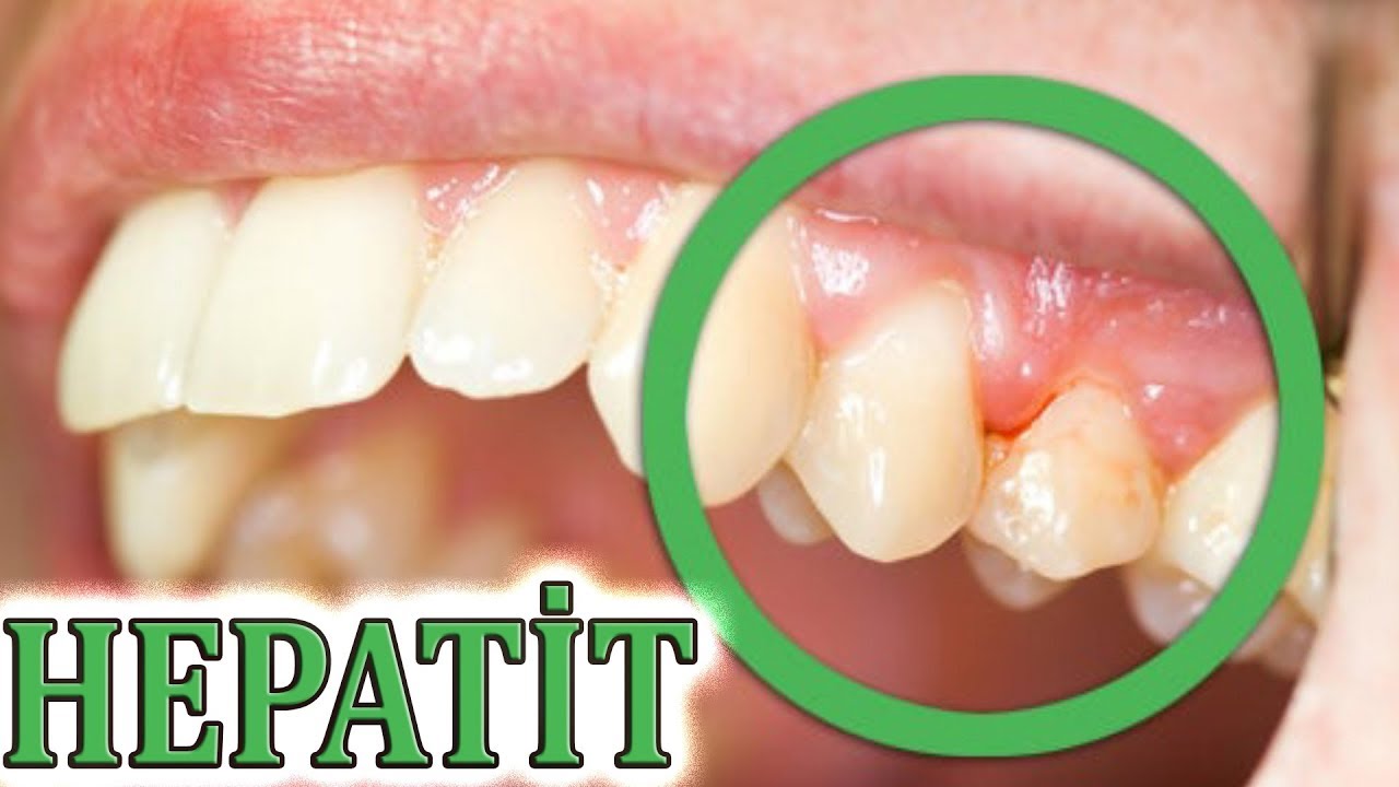 Hepatitlər necə yoluxur? - Necə QORUNAQ?