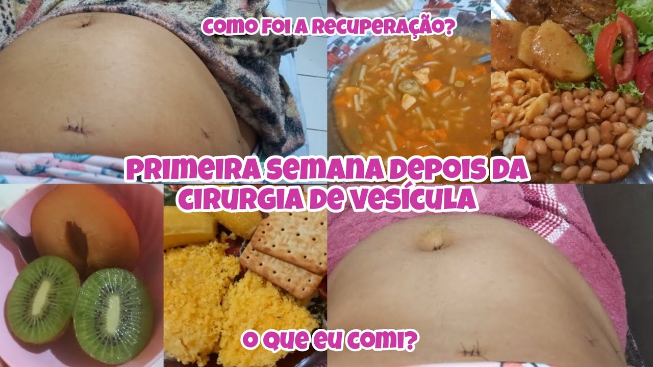 Primeira semana depois da cirurgia de vesícula | O que comi? Como foi a recuperação?