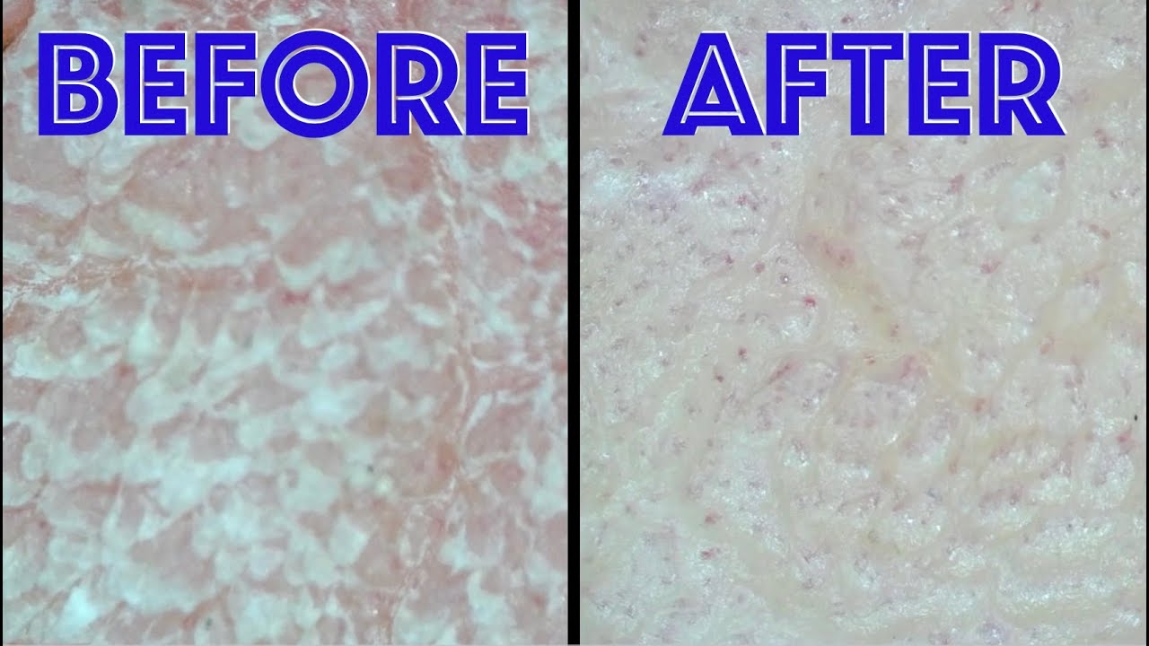 Dry Elbow Treatment Under Microscope
