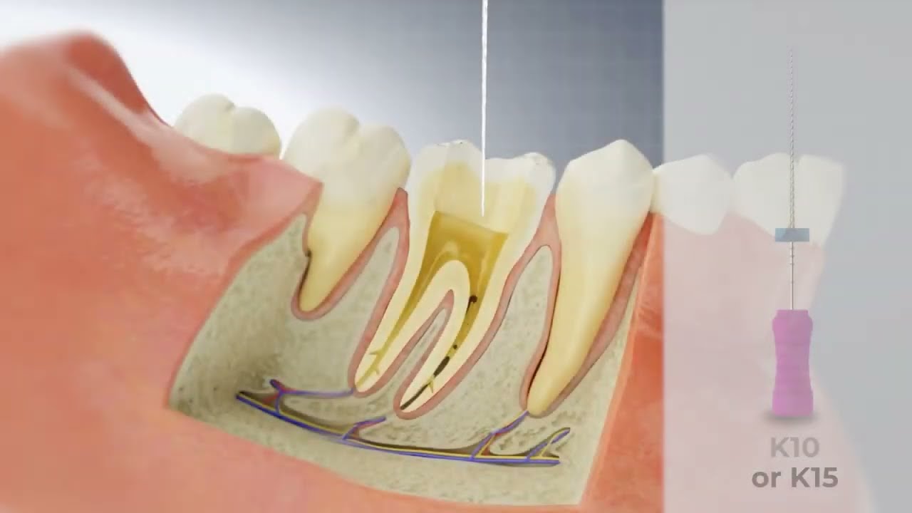 Achieving Patency with Bassi Logic - Conservative Endodontics