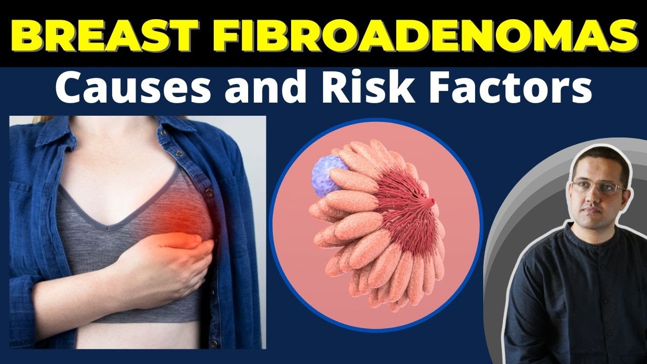 Breast Fibroadenoma Treatment Without Surgery By Dr. Gaurav Gangwani (IR)