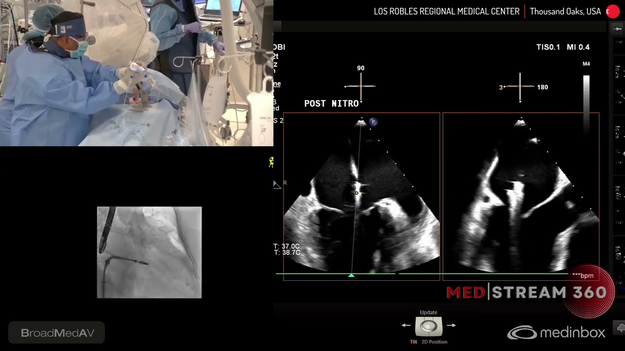 MitraClip for Severe Mitral and Tricuspid Valves Regurgitation In An Elderly Patient
