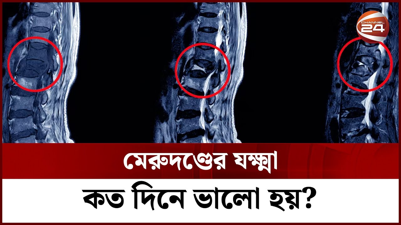মেরুদণ্ডের যক্ষ্মা কত দিনে ভালো হয়? || Backbone TB || Channel 24