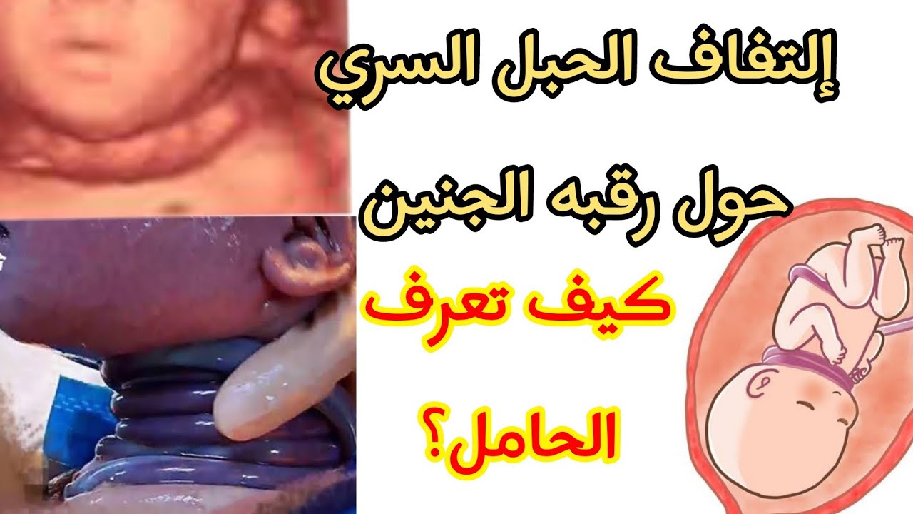 إلتفاف الحبل السري حول رقبه الجنين و اختناق الجنين اثناء النوم وكيف تعرف الحامل وما الحل؟