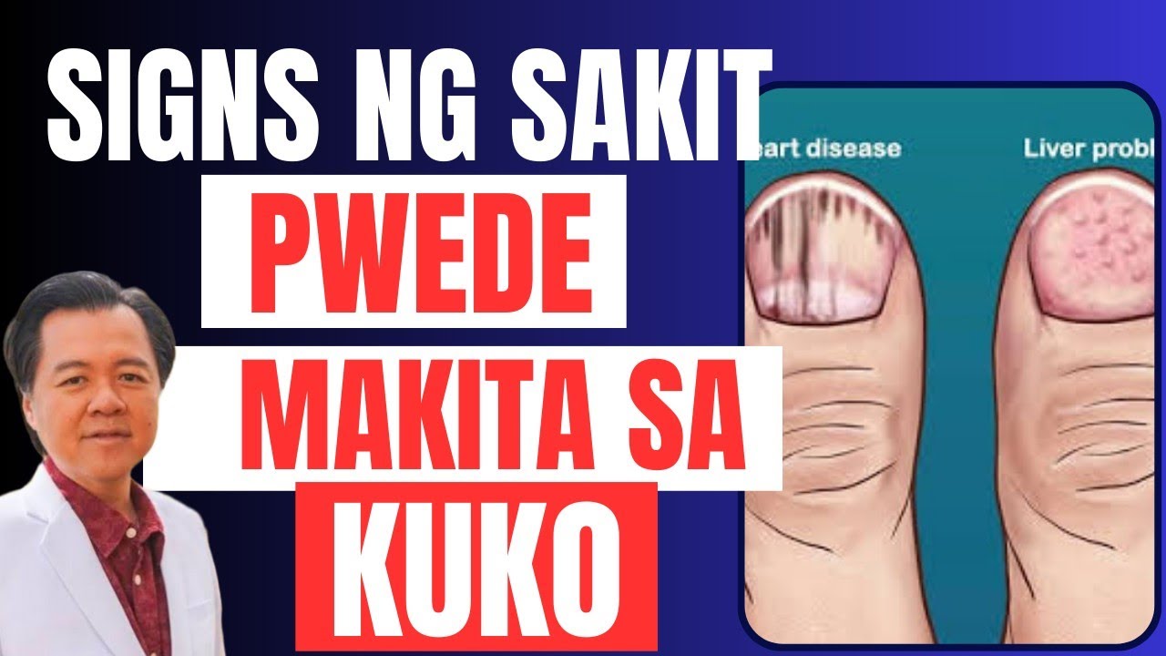 Signs ng Sakit na Pwedeng Makita sa Kuko - Payo ni Doc Willie Ong