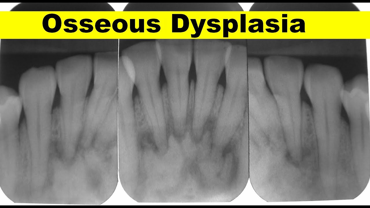 Osseous Dysplasia Case Presentation