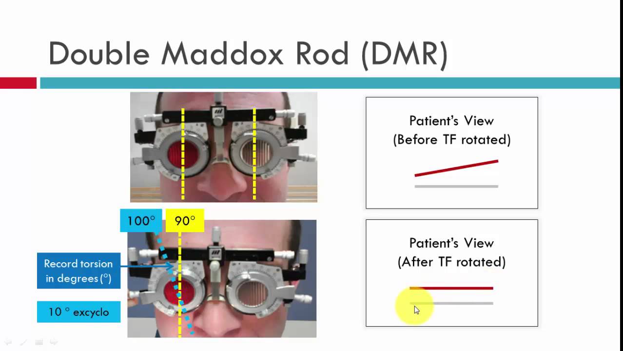 Assessment of Torsion