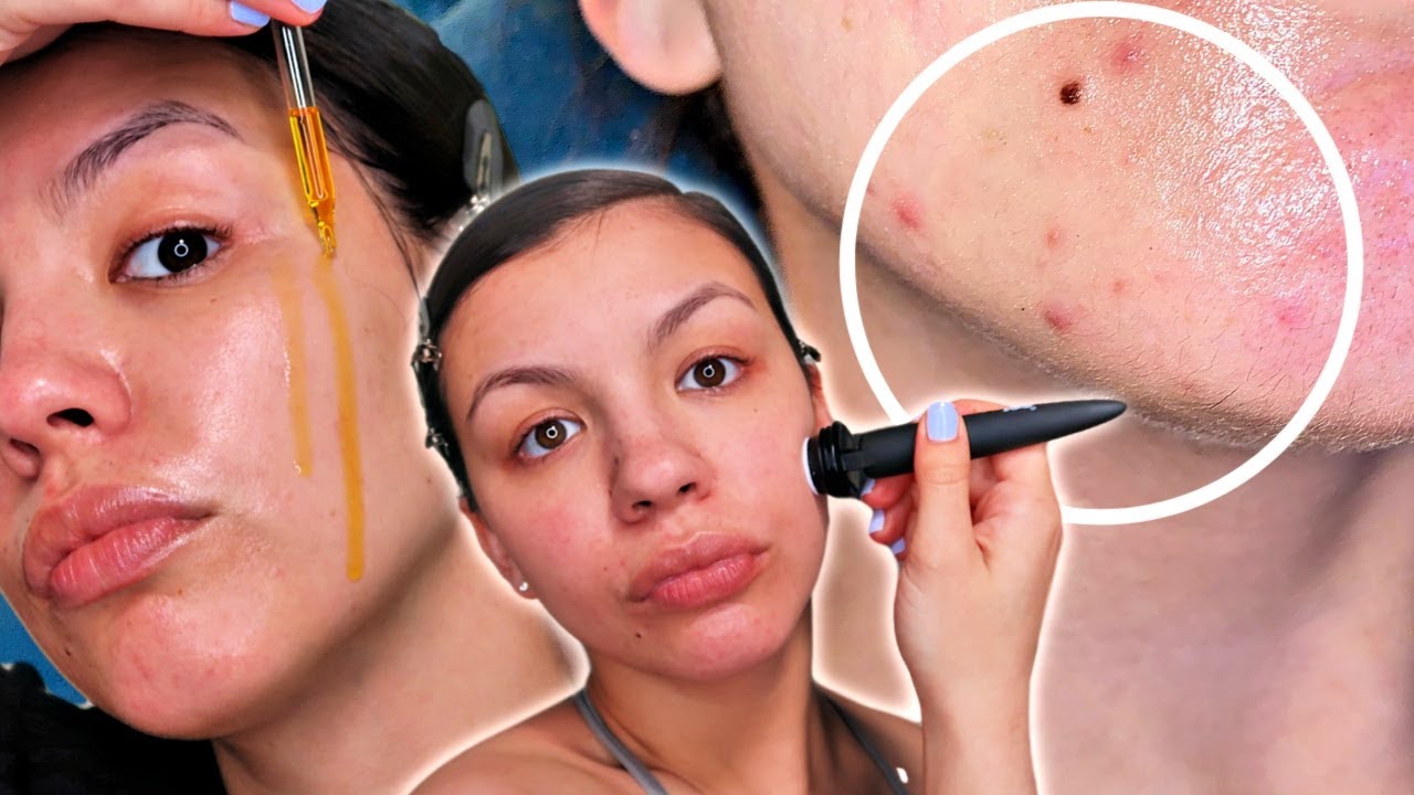 SKINCARE ROUTINE FOR ACNE SCARS, HYPERPIGMENTATION, AND DISCOLORATION