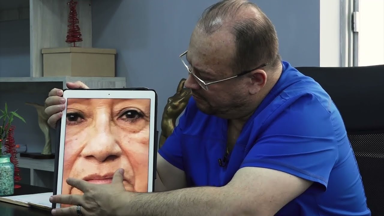 BLEFAROPLASTIA DOBLE para EMBELLECER la MIRADA ❤️ Bolsas y PÁRPADOS caídos 👀REAL 🤩 DR ALBERTO CALVO