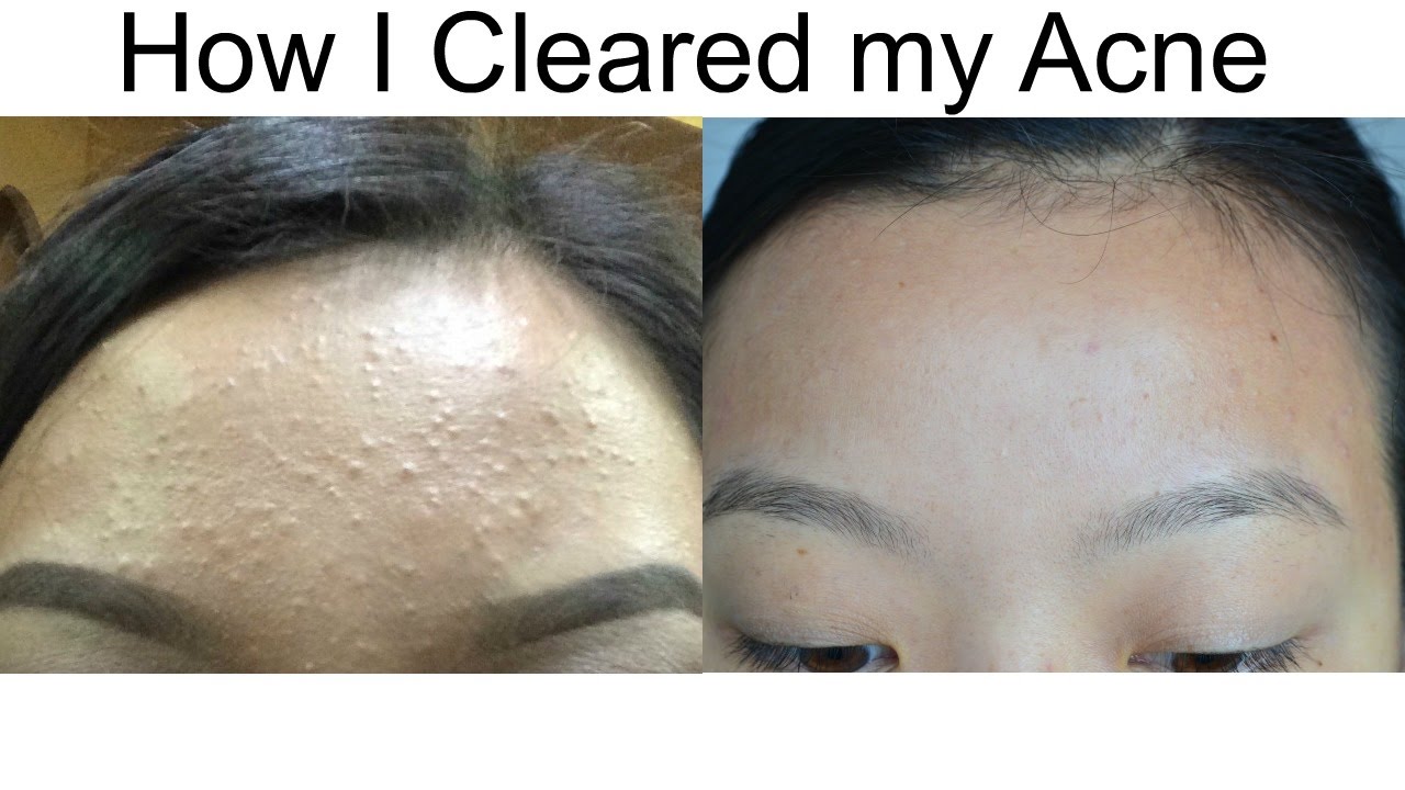 How I Cleared My Acne l (Baby Pimples)