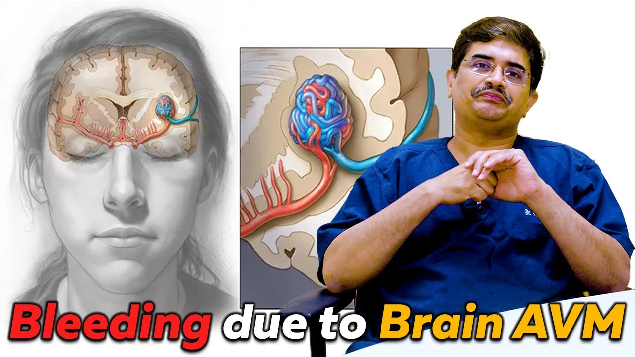 What is Brain AVM? - ArterioVenous Malformation  (AVM) - Treatment Options