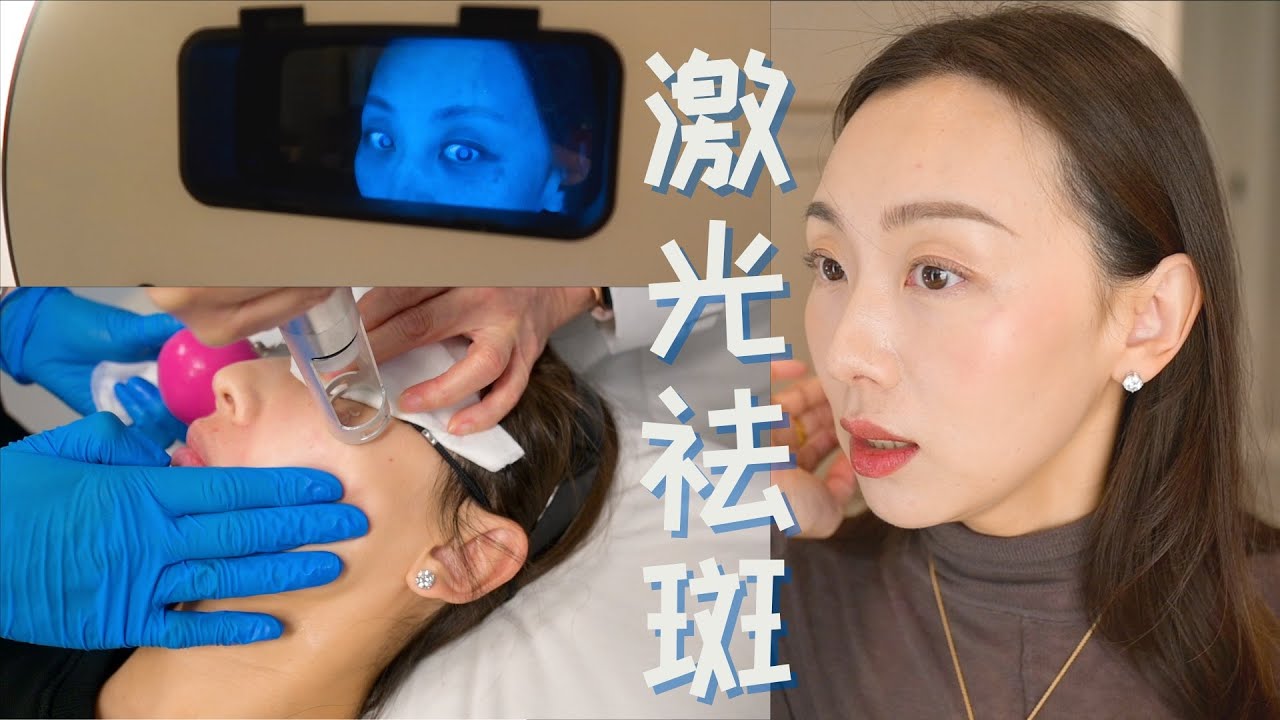【Anna阿姨 医美记录】光子嫩肤 皮秒祛斑 反黑怎么办