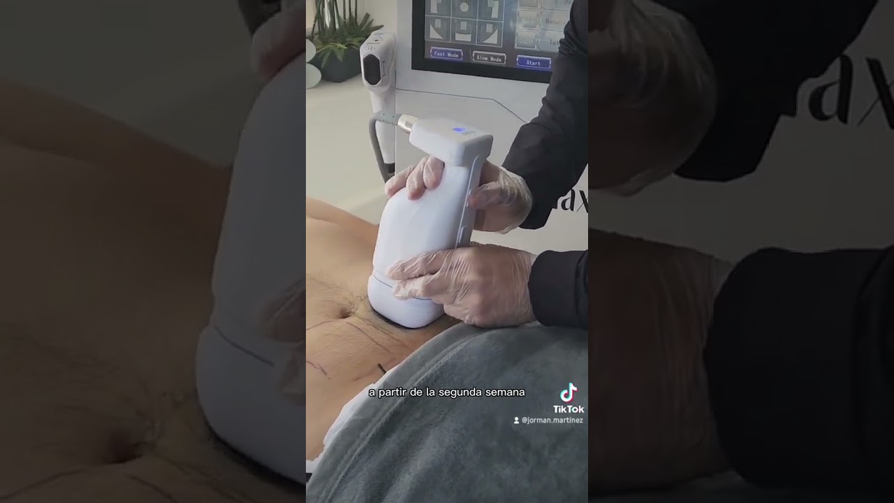Liposonix: Tratamiento para eliminar grasa localizada