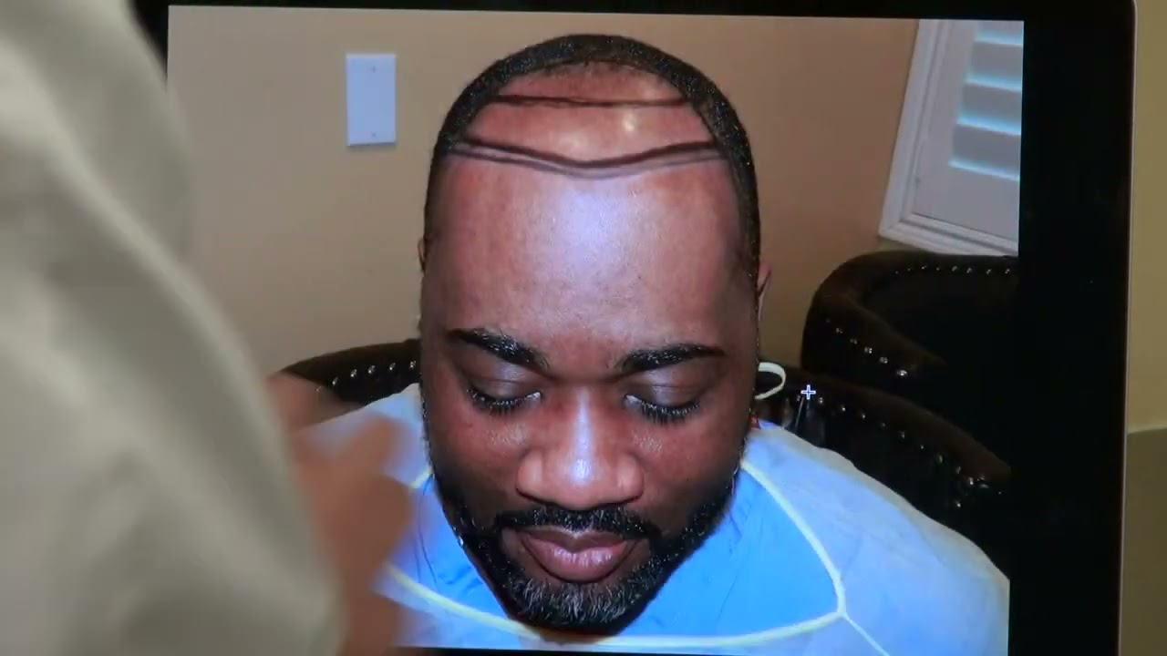 One Year Post Op Results on African American Curly Hair by Dr. John Diep