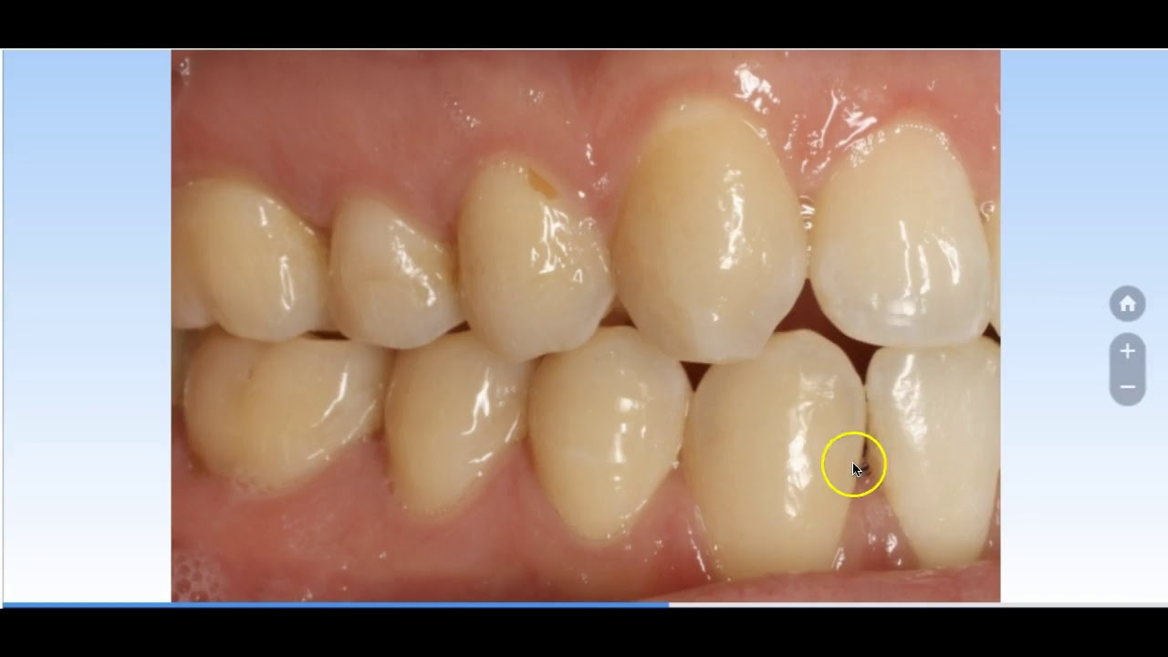 Dr Fournier invisalign et Carriere motion Laval